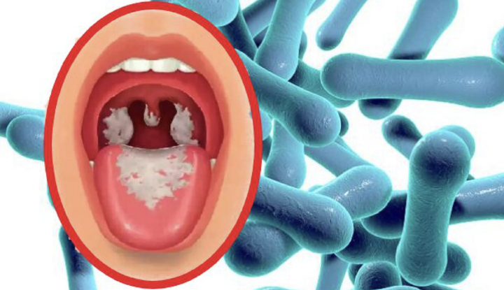 Triệu chứng và cách phòng bệnh bạch hầu