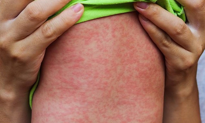 Bộ Y tế chỉ đạo nóng ngăn chặn bùng phát dịch sởi, ho gà