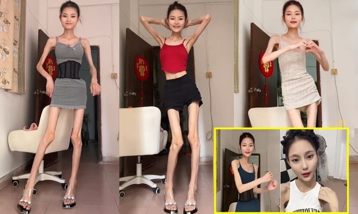 Bị gọi là Bạch Cốt Tinh do quá gầy, cô gái nặng 25kg vẫn muốn giảm cân