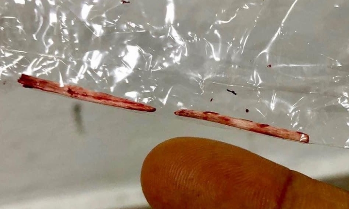 Sốt 7 ngày không giảm, đi khám phát hiện 'vật thể lạ' trong gan