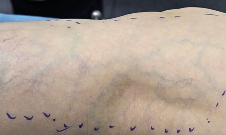 Tiêm xơ trị giãn tĩnh mạch, tại sao vẫn nổi lại gân xanh đỏ, nặng chân? 