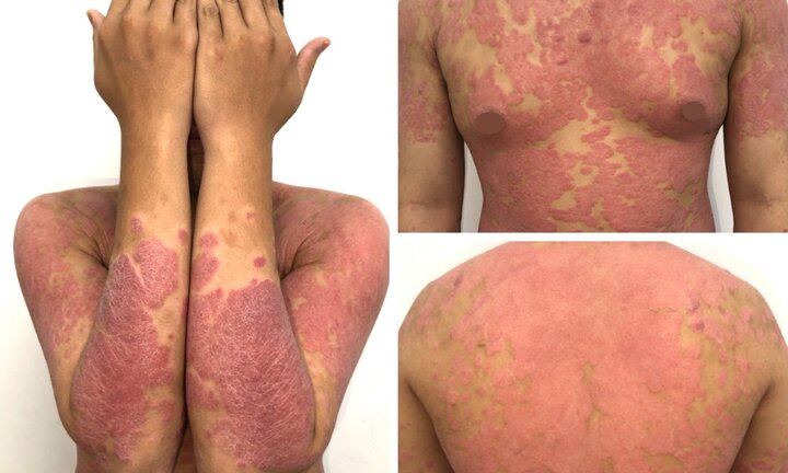 Căn bệnh khiến chàng trai da đỏ, sần sùi như khúc gỗ