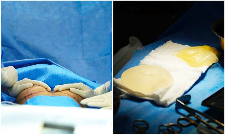 Nâng ngực - Kỹ thuật tạo hình khoang chính xác bằng dao siêu âm