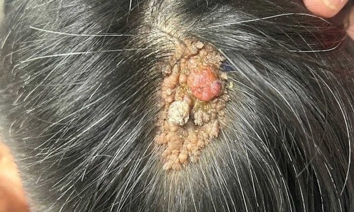 Vết bớt nhỏ trên đầu hoá ung thư ác tính