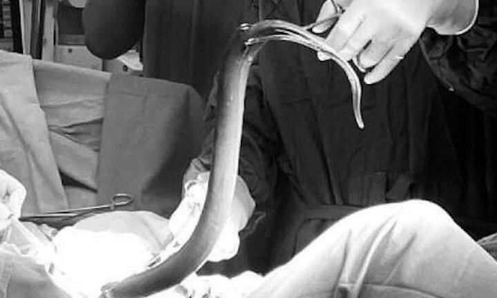 Nam thanh niên suýt mất mạng vì nhét con lươn vào hậu môn