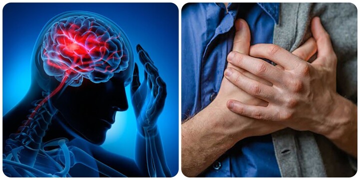 Nên làm gì khi có dấu hiệu đột quỵ?