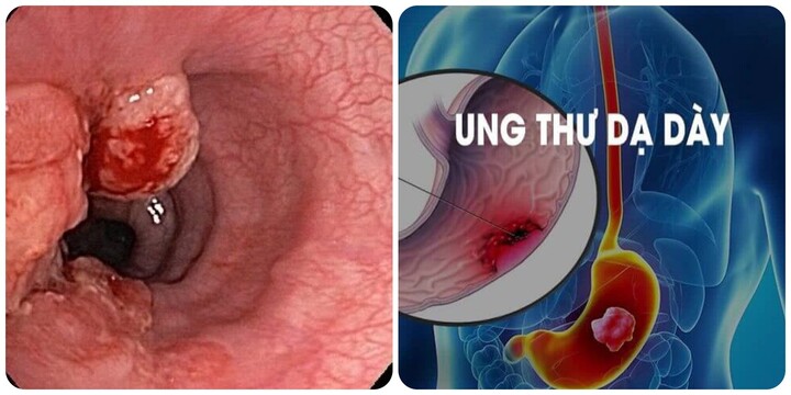 7 dấu hiệu ung thư dạ dày thường gặp không nên bỏ qua