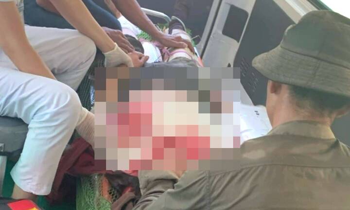 Người phụ nữ bị đá lớn lăn trúng người khi đi làm rừng, chấn thương sọ não