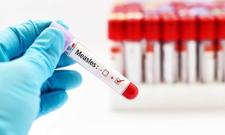 TP.HCM ghi nhận 3 trẻ tử vong liên quan bệnh sởi 