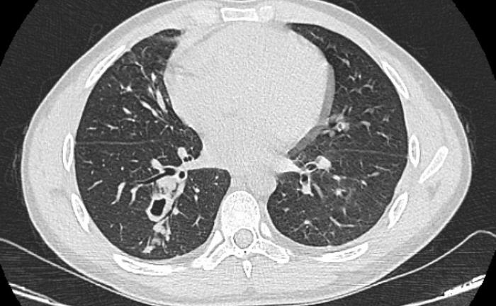 Ho ra máu, đi khám phát hiện sán làm tổ trong phổi