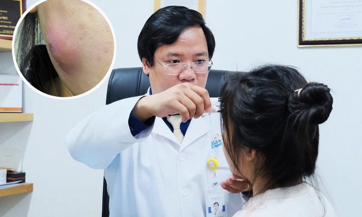 Suýt hoại tử mặt do tự ý nặn mụn