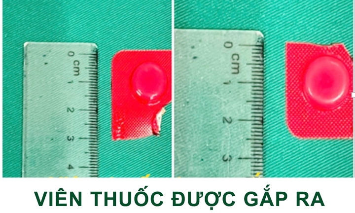 Uống cả nắm thuốc, sơ ý nuốt luôn viên còn nguyên vỏ cứng