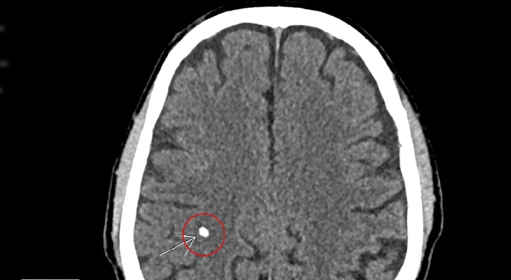 Chóng mặt, đau đầu, đi khám mới biết sán làm tổ trong não