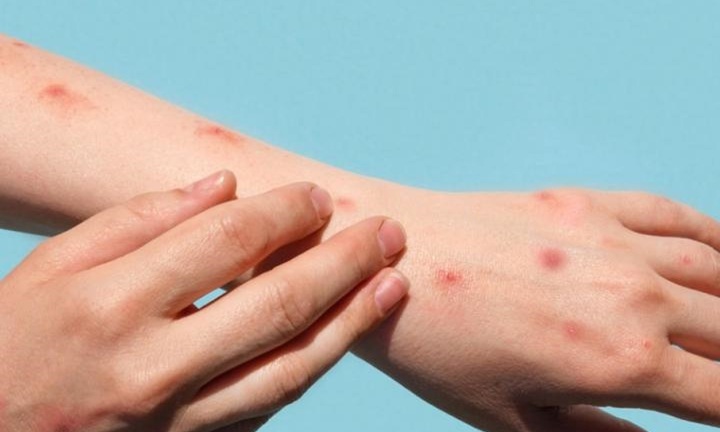 Việt Nam theo dõi sát tình hình dịch bệnh đậu mùa khỉ