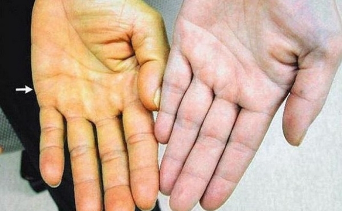 Suýt chết do uống nước lá chữa táo bón