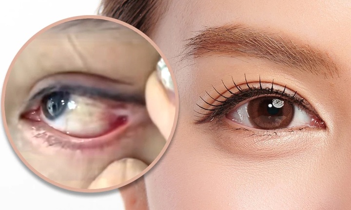 Đi cắt mí, cô gái bị khâu nhãn cầu với khóe mắt, muốn nhìn phải quay đầu