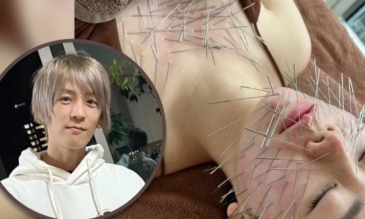 Rộ mốt châm kim đầy đầu để 'giết chết suy nghĩ', 30 phút tốn 34 triệu đồng