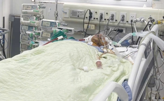 Giám đốc BV Bạch Mai thông tin sức khỏe 2 nạn nhân vụ lũ quét ở Làng Nủ