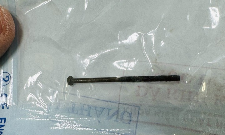 Gắp đinh vít dài 4 cm trong dạ dày bé trai 3 tuổi ở Quảng Ngãi