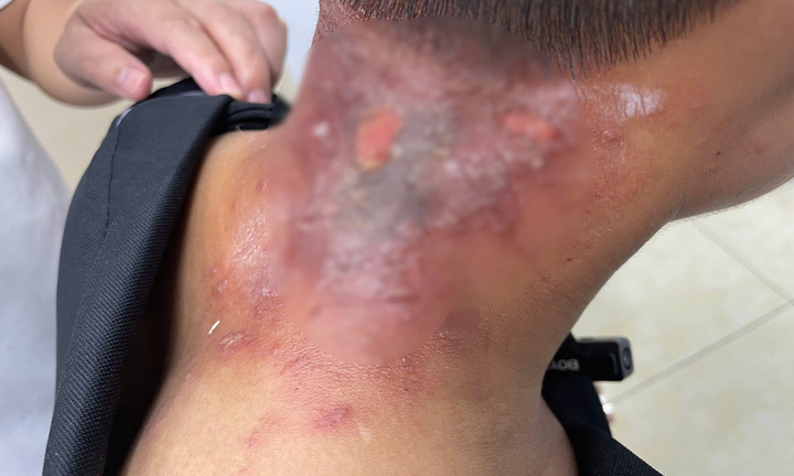 Lở loét da sau mưa lũ