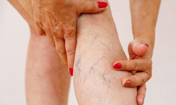 Suy giãn tĩnh mạch chân có nên đi bộ?