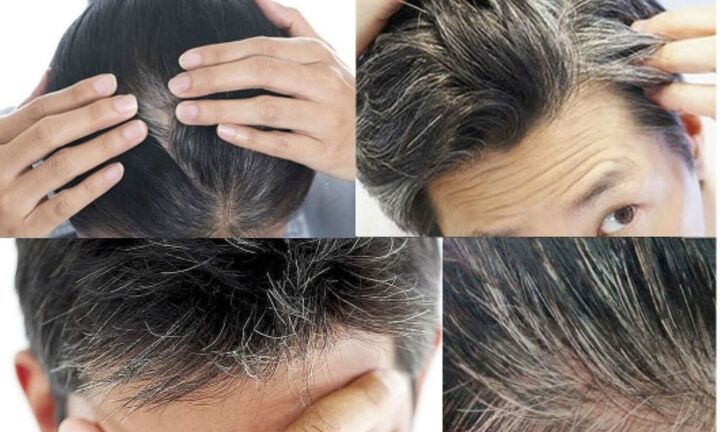 Làm thế nào để hạn chế tóc bạc sớm?