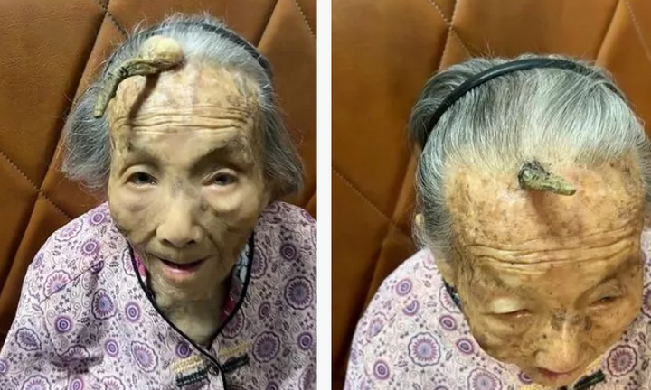 Kỳ lạ chiếc 'sừng trường thọ' dài 10cm trên trán cụ bà 107 tuổi