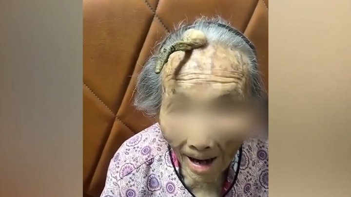 Cụ bà 107 tuổi tại Trung Quốc sở hữu chiếc 'sừng trường thọ'