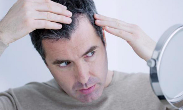 Nguyên nhân rụng tóc ở nam