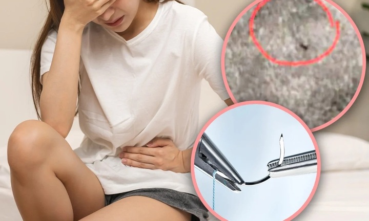 Đau đớn vật vã suốt 18 năm vì cây kim phẫu thuật bị 'quên' trong âm đạo