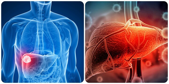 Những dấu hiệu cảnh báo ung thư gan giai đoạn đầu
