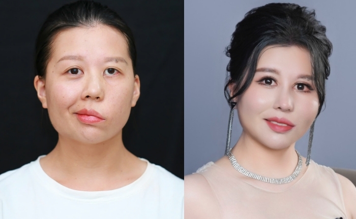 Cô gái 'mặt méo' lột xác sau 3 cuộc đại phẫu