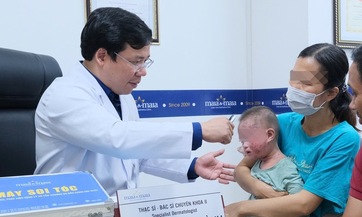 Em bé phồng rộp mặt, da chảy dịch vì tắm lá chữa viêm da cơ địa