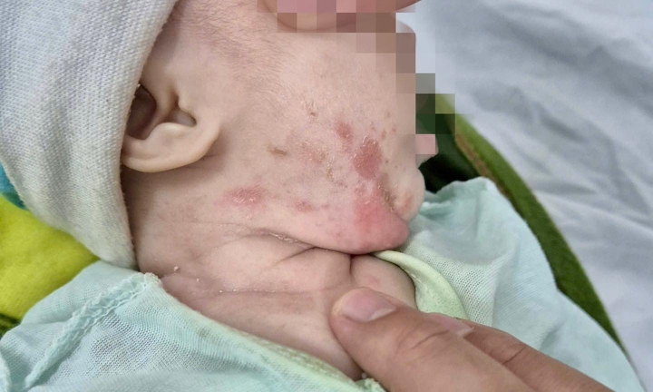 Bé gái hai tháng tuổi mắc giang mai