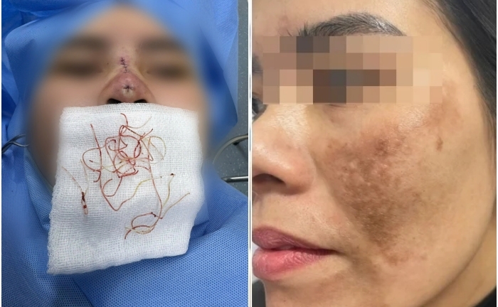 Thủng mũi sau 3 tháng làm đẹp ở spa