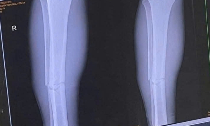 Gãy xương cẳng chân mất bao lâu mới có thể chơi thể thao lại?