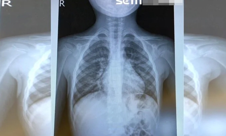 Virus HMPV tấn công Trung Quốc, bác sĩ kêu gọi làm ngay 2 việc