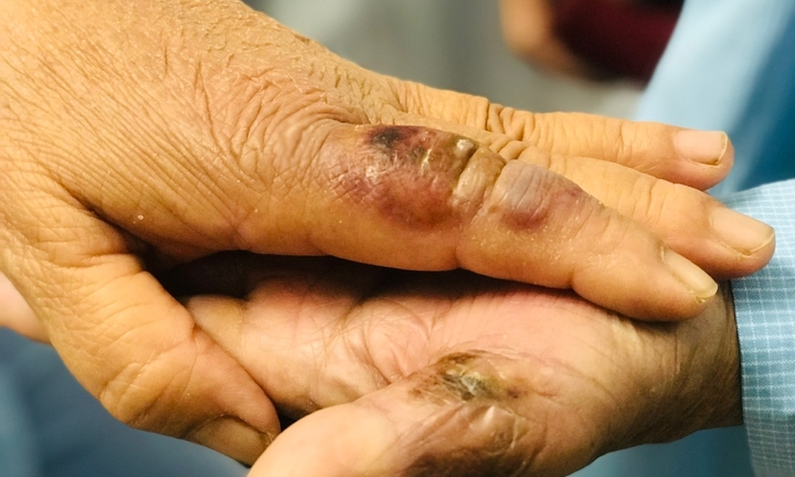 Bị chuột cắn vào tay, hai vợ chồng nhập viện