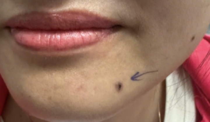 Phát hiện ung thư da từ chấm đen nhỏ như hạt đỗ