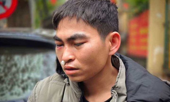 Nam shipper bị tài xế Lexus hành hung gây chấn động não, tỷ lệ thương tích 3%