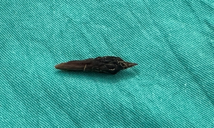 Thủng ruột do nuốt hạt táo đỏ