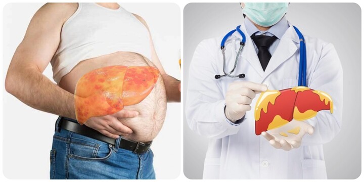 7 dấu hiệu gan không tốt cần đi khám ngay