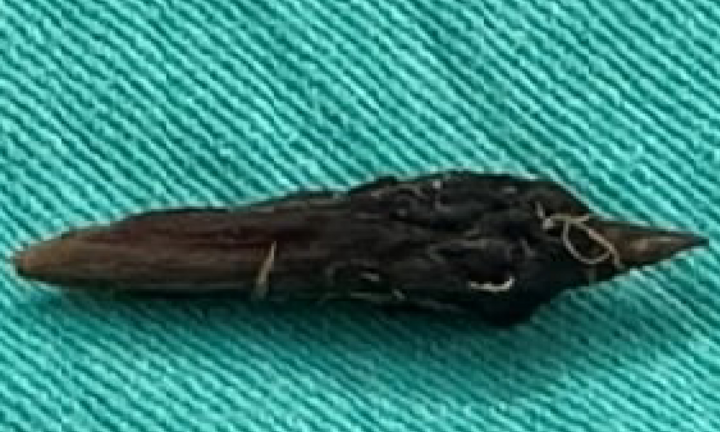 Nhiễm trùng ổ bụng, thủng ruột do nuốt hạt táo đỏ 