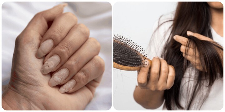 6 dấu hiệu thiếu sắt ở người lớn