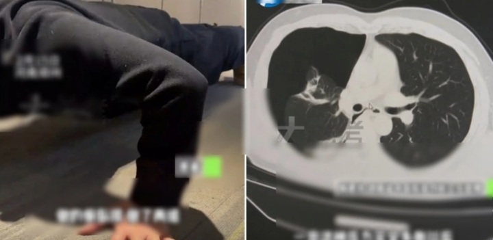 Xẹp phổi sau 20 lần chống đẩy và nhảy dây