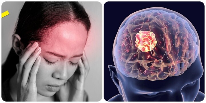 Ung thư não có những triệu chứng gì?