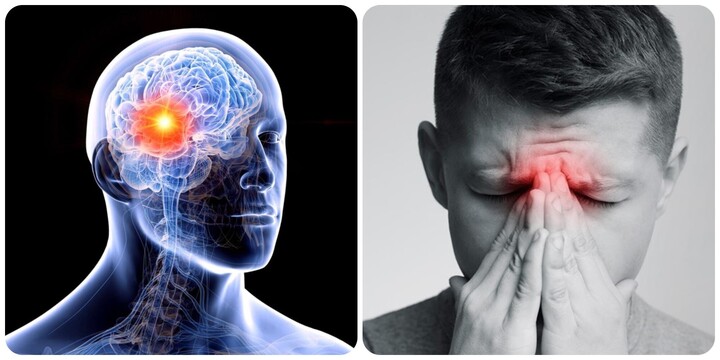 5 dấu hiệu u não giai đoạn đầu 