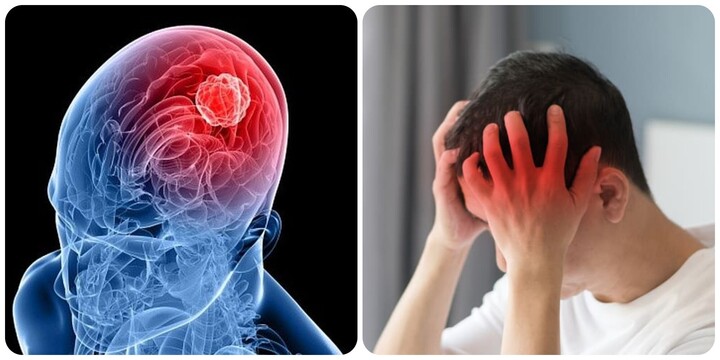 Dấu hiệu u não ác tính không nên bỏ qua