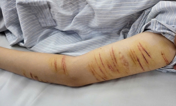 Tự rạch tay để giải tỏa stress: Bác sĩ khuyến cáo căn bệnh nguy hiểm