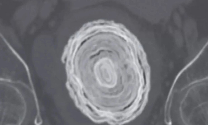 Liên tục tiểu ra máu, đi khám phát hiện thứ to như quả bóng chày trong cơ thể